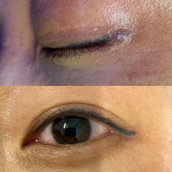 COSMETIC TATTOO REMOVAL Infinity Cosmetic Tattoo